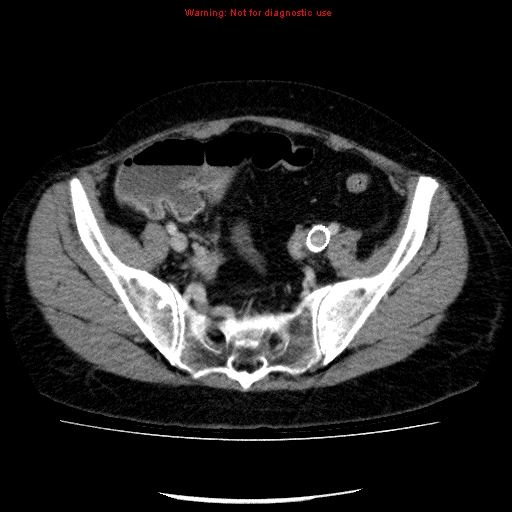 Acute gangrenous cholecystitis (Radiopaedia 10123-10661 Axial C+ portal venous phase 82).jpg