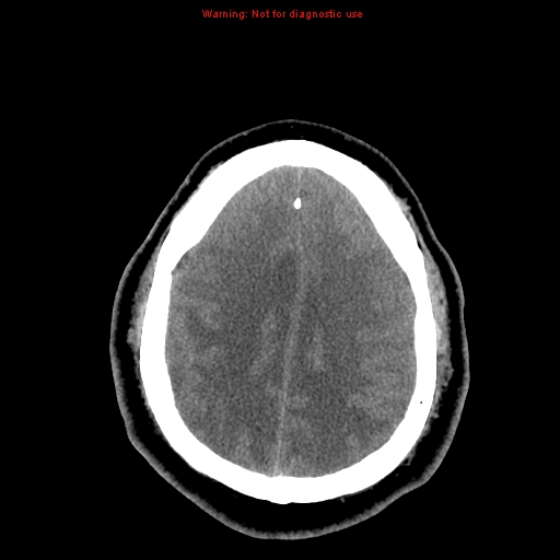 Acute hemorrhagic leukoencephalitis (Radiopaedia 14076-13920 Axial non-contrast 38).jpg