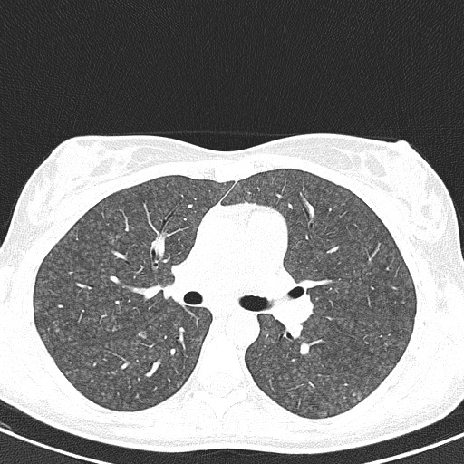 File:Acute hypersensitivity pneumonitis (Radiopaedia 85293-100870 Axial lung window 49).jpg