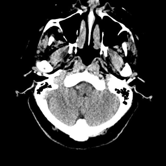 Acute middle cerebral artery territory infarct (Radiopaedia 52380-58283 Axial non-contrast 11).jpg