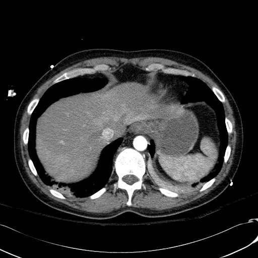 Acute myocardial infarction in CT (Radiopaedia 39947-42415 Axial C+ arterial phase 121).jpg
