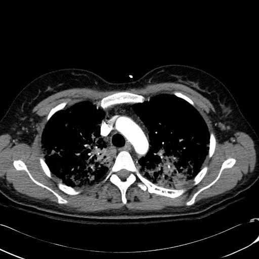 Acute myocardial infarction in CT (Radiopaedia 39947-42415 Axial C+ arterial phase 37).jpg