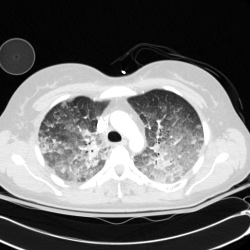 Acute myocardial infarction in CT (Radiopaedia 39947-42415 Axial lung window 35).jpg
