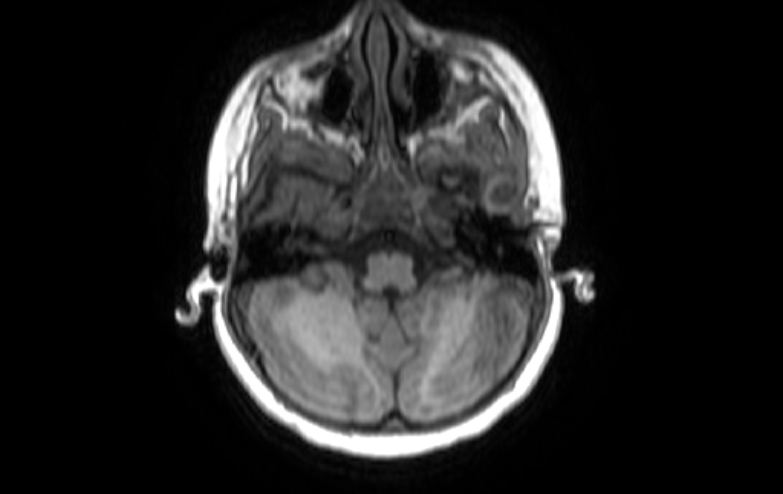 Acute necrotizing encephalitis of childhood (Radiopaedia 67356-76737 Axial T1 77).jpg