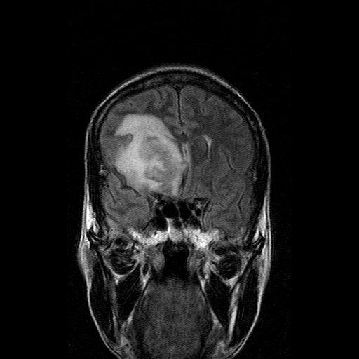 File:Acute necrotizing toxoplasma encephalitis (Radiopaedia 10683-11149 Coronal FLAIR 14).jpg
