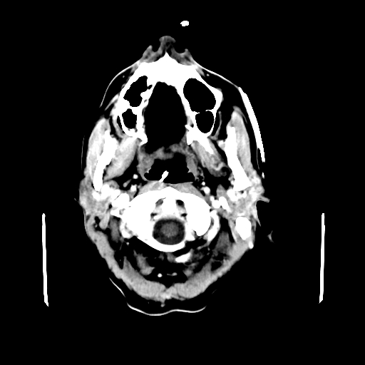 File:Acute necrotizing toxoplasma encephalitis (Radiopaedia 10683-11150 C+ arterial phase 32).jpg