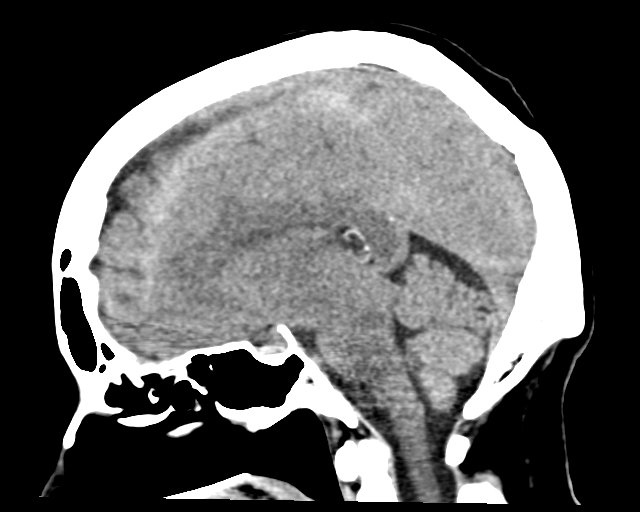Acute on chronic subdural hemorrhage (Radiopaedia 85330-100923 Sagittal non-contrast 37).jpg