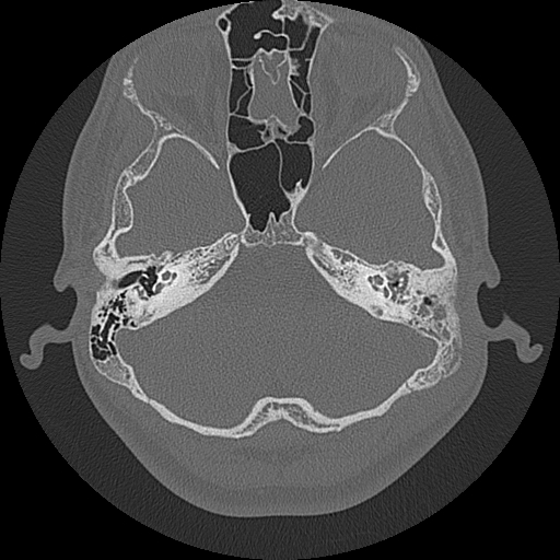 Acute otomastoiditis and Bezold abscess (Radiopaedia 88184-104786 Axial bone window 33).jpg