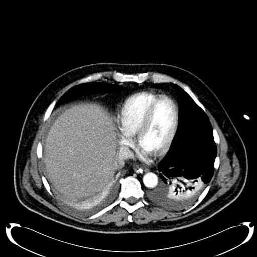 File:Acute pancreatic necrosis (Radiopaedia 13560-18500 Axial C+ portal venous phase 18).jpg