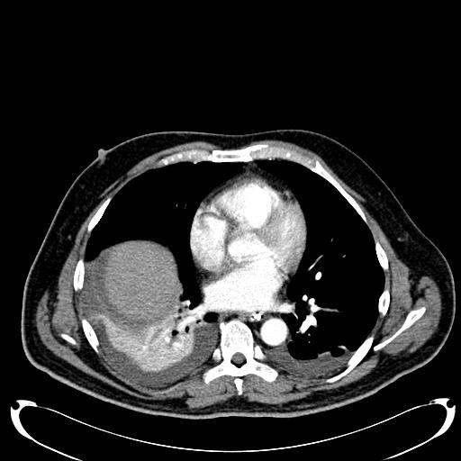 File:Acute pancreatic necrosis (Radiopaedia 13560-18500 Axial C+ portal venous phase 6).jpg