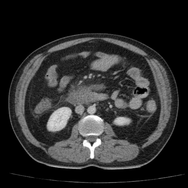 Acute pancreatitis (Radiopaedia 26663-26813 Axial C+ portal venous phase 43).jpg