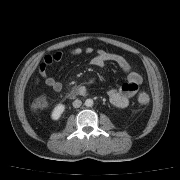 Acute pancreatitis (Radiopaedia 26663-26813 Axial C+ portal venous phase 46).jpg