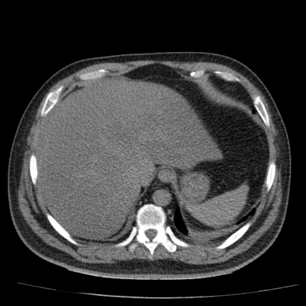 Acute pancreatitis (Radiopaedia 26663-26813 Axial non-contrast 20).jpg