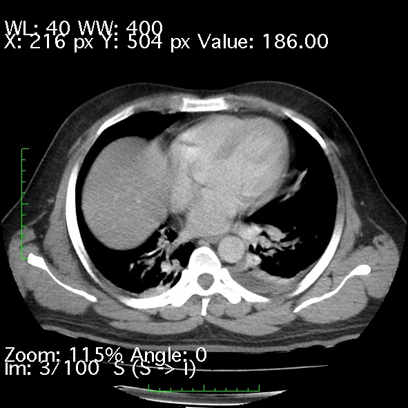 File:Acute pancreatitis (Radiopaedia 34043-35276 Axial C+ portal venous phase 3).jpg