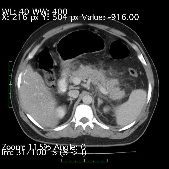 File:Acute pancreatitis (Radiopaedia 34043-35276 Axial C+ portal venous phase 31).jpg