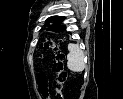 Acute pancreatitis (Radiopaedia 85146-100701 Sagittal C+ portal venous phase 87).jpg