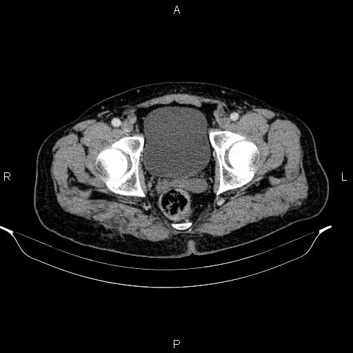 Acute pancreatitis (Radiopaedia 85390-101010 Axial C+ portal venous phase 103).jpg