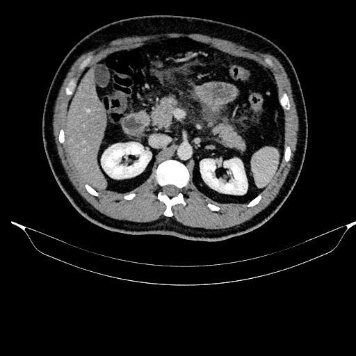 Acute pancreatitis (Radiopaedia 87428-103757 Axial C+ portal venous phase 38).jpg