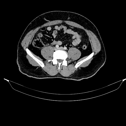 File:Acute pancreatitis (Radiopaedia 87428-103757 Axial C+ portal venous phase 67).jpg