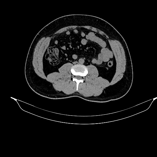 File:Acute pancreatitis (Radiopaedia 87428-103757 Axial non-contrast 57).jpg