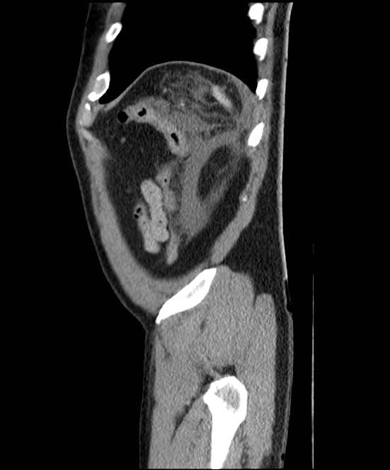Acute pancreatitis - Balthazar E (Radiopaedia 23080-23110 Sagittal C+ portal venous phase 90).jpg