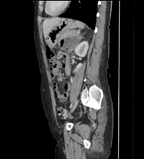 Acute pancreatitis - Balthazar E - post ERCP (Radiopaedia 27562-27772 Sagittal C+ portal venous phase 91).png