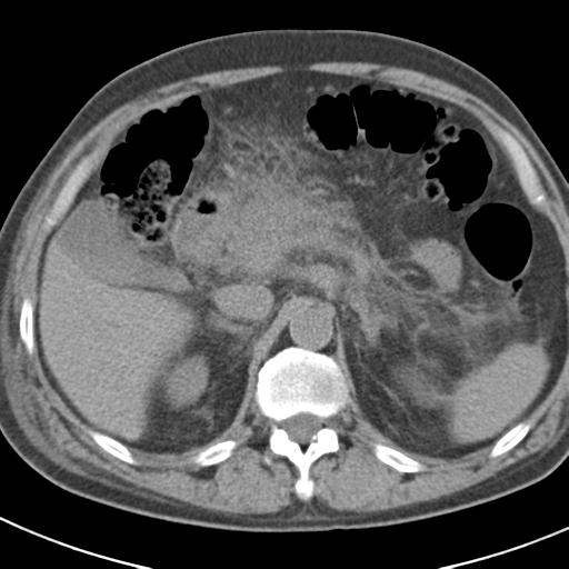 File:Acute pancreatitis and walled-off necrosis (Radiopaedia 29888-30403 Axial non-contrast 21).jpg