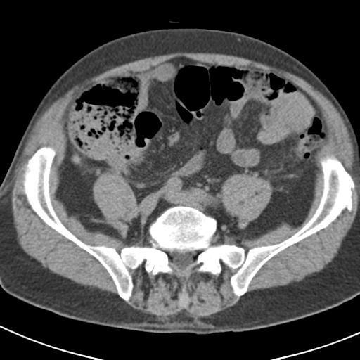 File:Acute pancreatitis and walled-off necrosis (Radiopaedia 29888-30403 Axial non-contrast 53).jpg