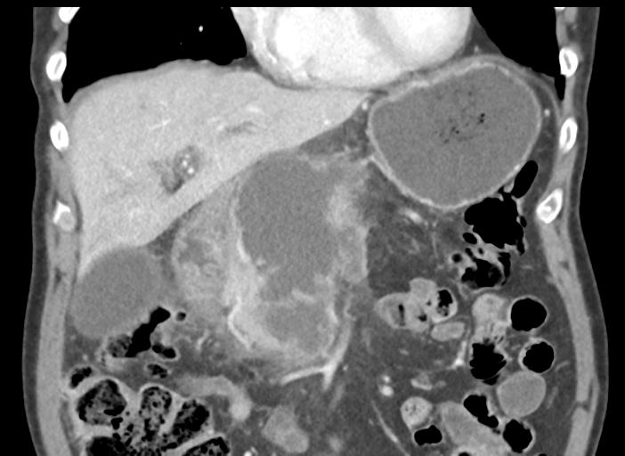 Acute pancreatitis and walled-off necrosis (Radiopaedia 29888-30404 Coronal C+ portal venous phase 19).jpg