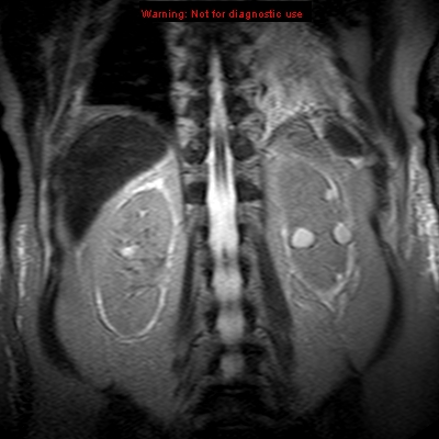 File:Acute pancreatitis with incidental pancreatic lipoma (Radiopaedia 10190-10732 Coronal T2 26).jpg
