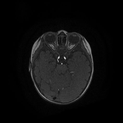 Acute phase of hemiconvulsion-hemiplegia epilepsy syndrome (Radiopaedia 29309-29745 Axial TOF angiography 91).jpg