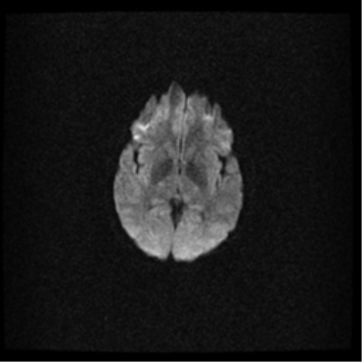 File:Acute pontine infarct from vertebral artery dissection (Radiopaedia 34111-35370 Axial DWI 11).png