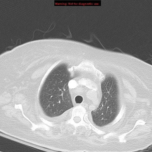 File:Acute pulmonary embolism (Radiopaedia 13286-13289 B 10).jpg