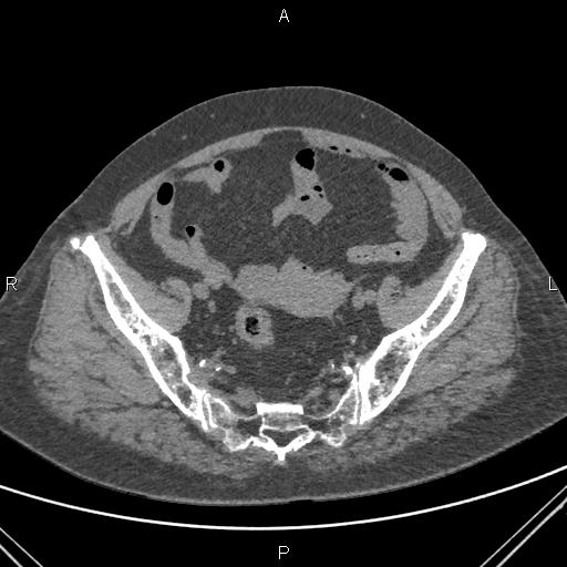 Acute renal artery occlusion (Radiopaedia 86586-102682 Axial non-contrast 75).jpg