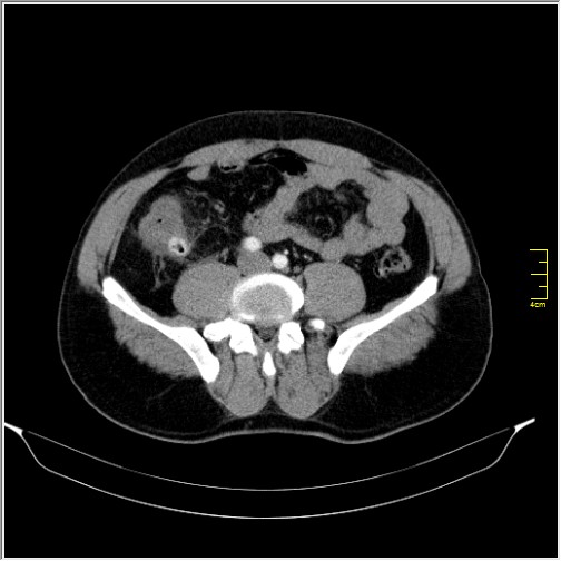 Acute right sided diverticulitis (Radiopaedia 65249-74268 Axial C+ portal venous phase 51).JPG