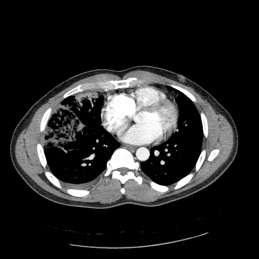 Acute segmental pulmonary emboli and pulmonary infarction (Radiopaedia 62264-70444 Axial C+ CTPA 72).jpg