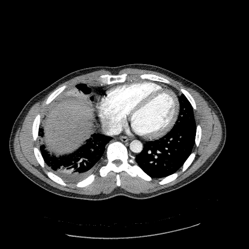 Acute segmental pulmonary emboli and pulmonary infarction (Radiopaedia 62264-70444 Axial C+ CTPA 80).jpg