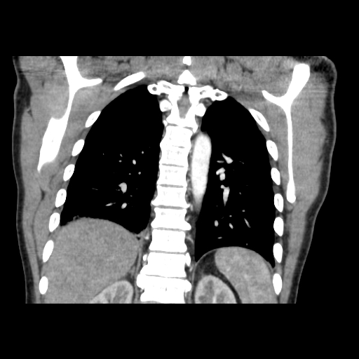 Acute segmental pulmonary emboli and pulmonary infarction (Radiopaedia 62264-70444 Coronal C+ CTPA 41).jpg