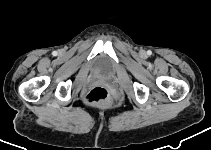 Acute small bowel (ileal) volvulus (Radiopaedia 71740-82139 Axial C+ portal venous phase 199).jpg