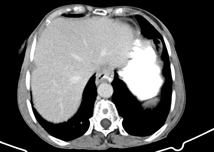 Acute small bowel (ileal) volvulus (Radiopaedia 71740-82139 Axial C+ portal venous phase 44).jpg