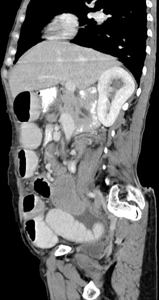 Acute small bowel (ileal) volvulus (Radiopaedia 71740-82139 Sagittal C+ portal venous phase 106).jpg