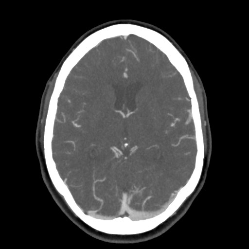 Acute subarachnoid hemorrhage and accessory anterior cerebral artery (Radiopaedia 69231-79009 D 36).jpg
