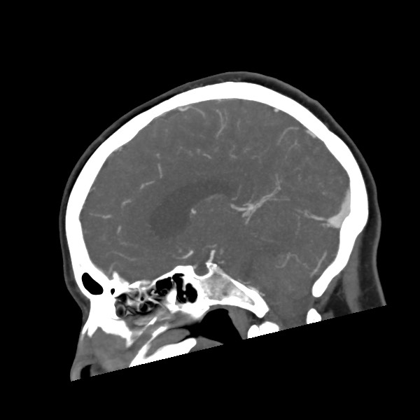 File:Acute subarachnoid hemorrhage and accessory anterior cerebral artery (Radiopaedia 69231-79009 Sagittal C+ arterial phase 40).jpg