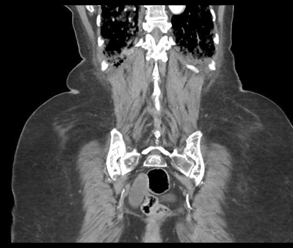 File:Acute superior mesenteric artery occlusion (Radiopaedia 43926-47418 Coronal C+ portal venous phase 42).png