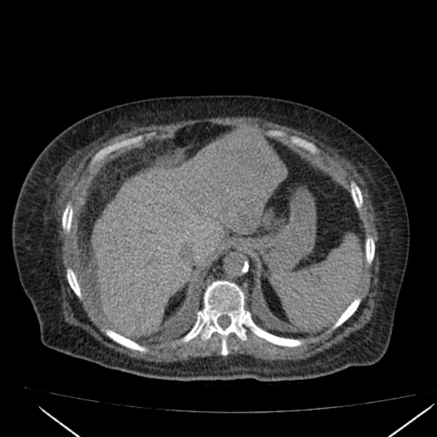 Acute tubular necrosis (Radiopaedia 28077-28334 Axial non-contrast 15).jpg
