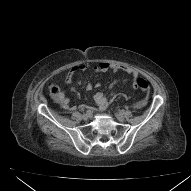 Acute tubular necrosis (Radiopaedia 28077-28334 Axial non-contrast 50).jpg