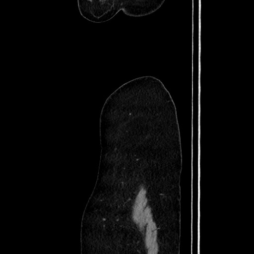 Acute uncomplicated appendicitis (Radiopaedia 73704-84499 Sagittal C+ portal venous phase 30).jpg