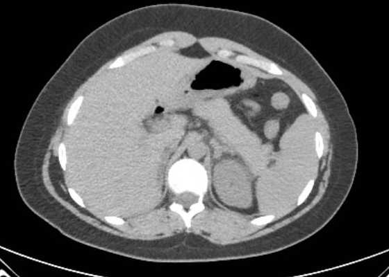 Acute unilateral nonhemorrhagic adrenal infarction (Radiopaedia 67560-76957 Axial non-contrast 26).jpg