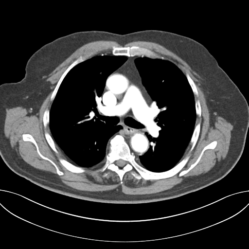 Adenocarcioma of rectum- T1 lesion (Radiopaedia 36921-38547 Axial C+ arterial phase 25).png