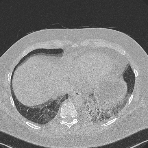 Adenoid cystic carcinoma of the trachea (Radiopaedia 49042-54137 Axial lung window 271).jpg